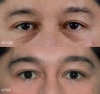 Eye Bag Surgery